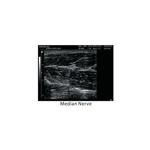 MINDRAY DP-20 ULTRASOUND SCANNER WITH LED MONITOR AND 1 CONVEX PROBE