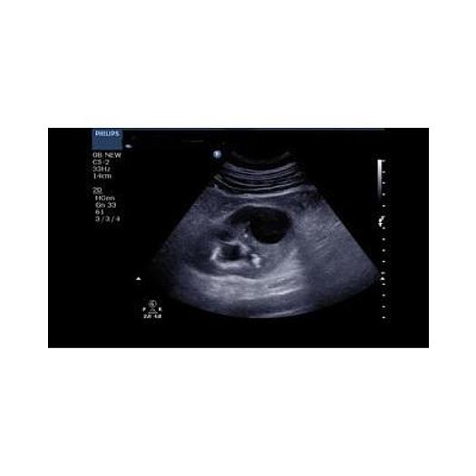 Used PHILIPS HD3 COLOR DOPPLER ULTRASOUND WITH ABDOMINAL PROBE AND ENDOVAGINAL PROBE