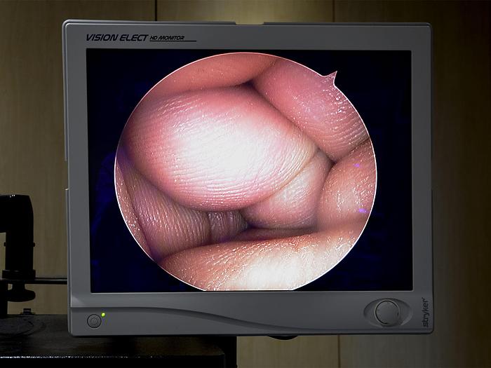 Used STRYKER ARTHROSCOPY SET