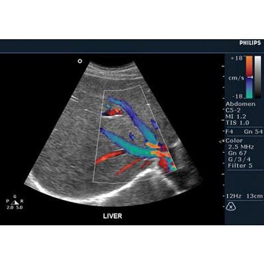 Used PHILIPS HD3 COLOR DOPPLER ULTRASOUND WITH ABDOMINAL PROBE AND ENDOVAGINAL PROBE
