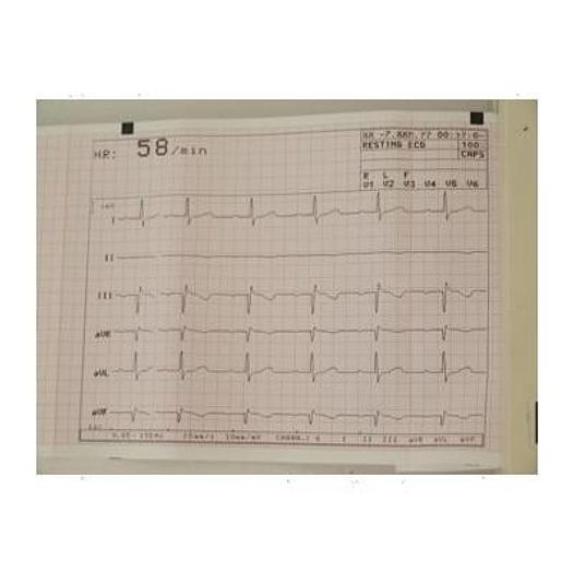 Used E.C.G SCHILLER AT-5 6 TRACKS WITH INTERPRETATION SOFTWARE