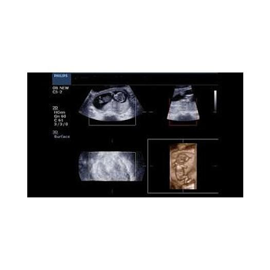 Used PHILIPS HD3 COLOR DOPPLER ULTRASOUND WITH ABDOMINAL PROBE AND ENDOVAGINAL PROBE