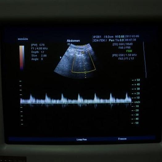 Used 3D/4D ULTRASOUND SCANNER MEDISON ACCUVIX XQ WITH VOLUME PROBE