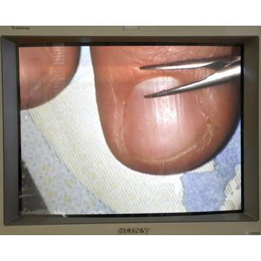 Used STORZ URBAN OPHTHALMIC OPERATING MICROSCOPE, FOOT CONTROLS FOR XY, ZOOM, FOCUS