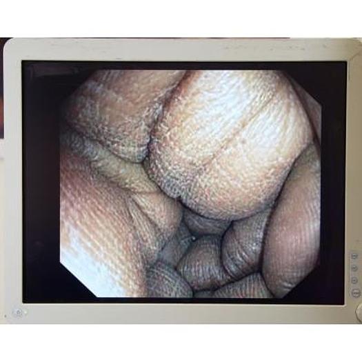 Used OLYMPUS GASTROSCOPY COLUMN WITH FLAT SCREEN 180 SERIES