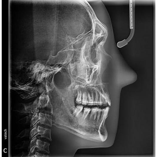 Used VATECH PAX I 3D SMART DENTAL PANORAMIC with CEPHALOSTAT (Panorama + Cephalo Scan Shot + CBCT)