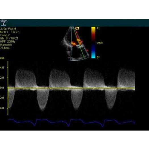 Used ACUSON SIEMENS CYPRESS COLOR PORTABLE ECHOCARDIOGRAPH WITH CART