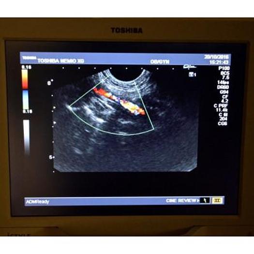Used ULTRASOUND SCANNER TOSHIBA NEMIO XG ISTYLE SSD 580A COLOR, DOPPLER, FLAT SCREEN