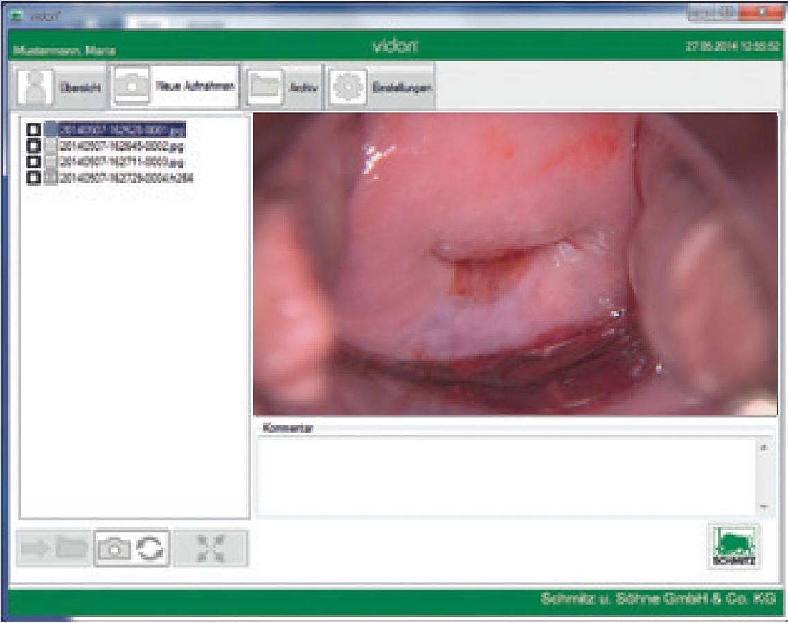 Rénové FAUTEUIL GYNÉCOLOGIQUE SCHMITZ MEDI-MATIC AVEC VIDEO COLPOSCOPE VIDAN INTEGRÉ ET ECRAN