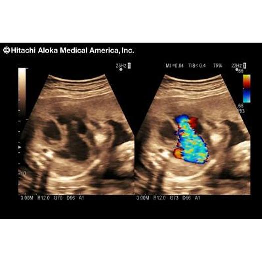 Used ALOKA/HITACHI PROSOUND 3500SX COLOR ULTRASOUND SCANNER