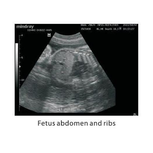 MINDRAY DP-10 ULTRASOUND SCANNER WITH LED MONITOR AND 1 CONVEX PROBE