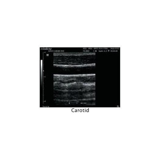 MINDRAY DP-20 ULTRASOUND SCANNER WITH LED MONITOR AND 1 CONVEX PROBE