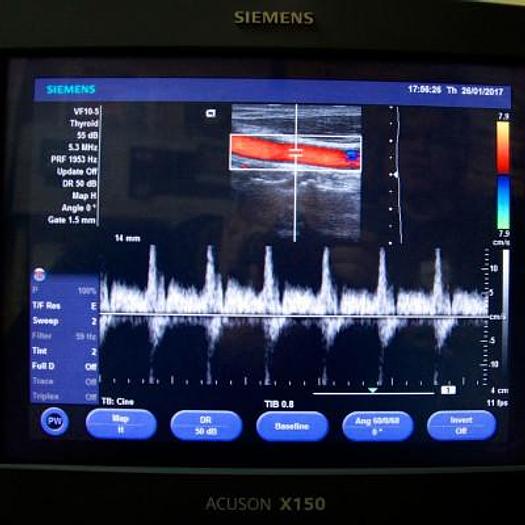 Used SIEMENS ACUSON X150 ULTRASOUND SCANNER WITH 3 PROBES AND FLAT SCREEN