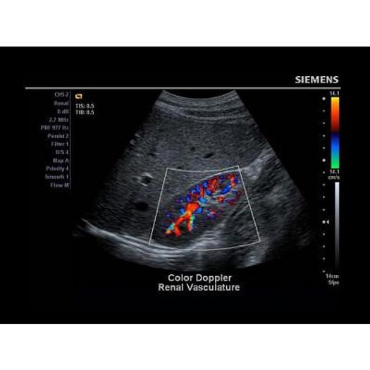 Used ULTRASOUND SIEMENS X150 FLAT SCREEN, COLOR DOPPLER WITH CONVEX ABDOMINAL PROBE 2-5 MHZ AND SUPERFICIAL LINE PROBE 5-10 M