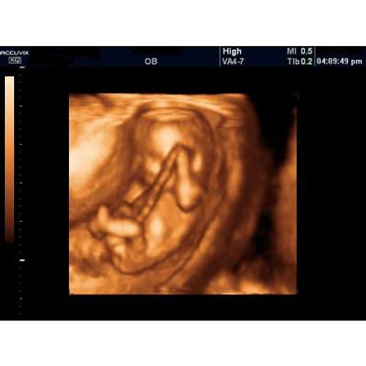 Used 3D/4D COLOR DOPPLER ULTRASOUND SCANNER, SAMSUNG MEDISON ACCUVIX XQ