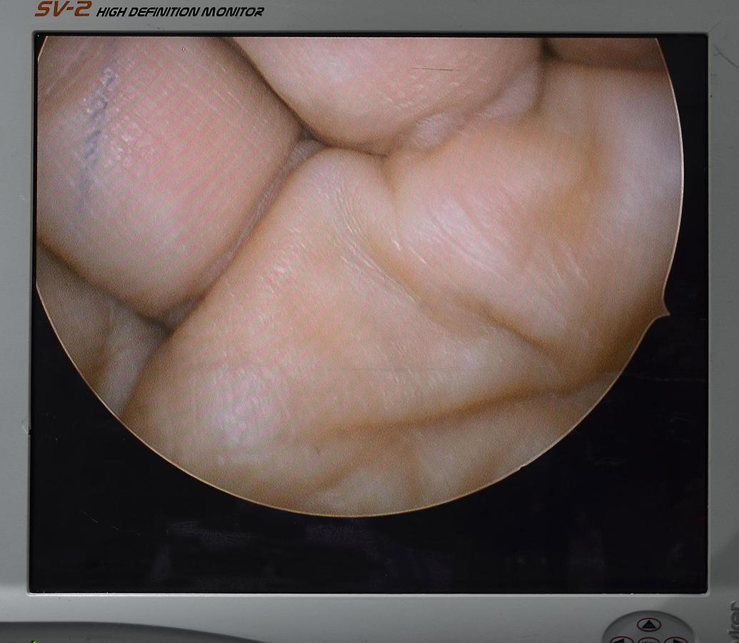 D'occasion KARL STORZ OPTICS UROLOGY/HYSTEROSCOPY 27005BA 30°