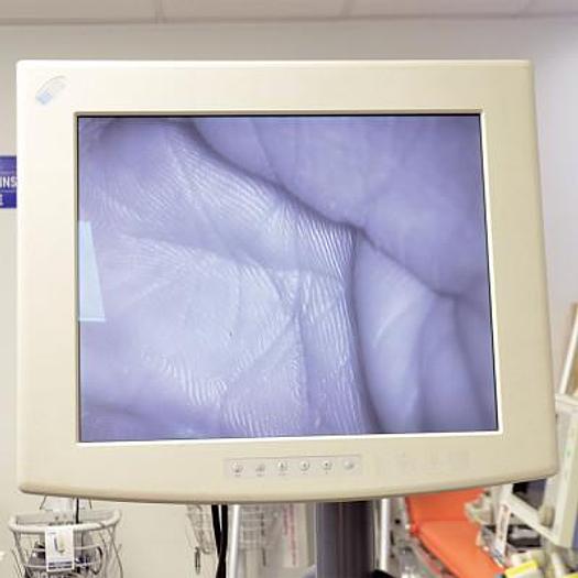 Used ZEISS NAG NC31 NEUROSURGERY MICROSCOPE WITH DOUBLE BINOCULARS