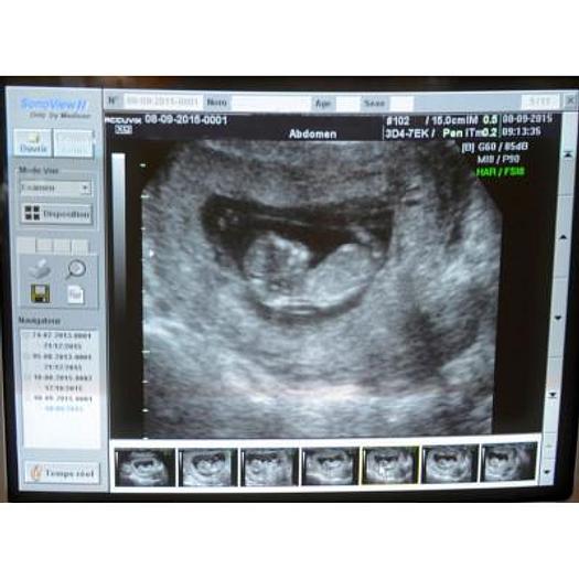 Used ACCUVIX XQ 3D/4D ULTRASOUND SCANNER WITH 4 PROBES