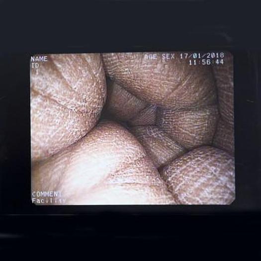 Used PENTAX EG-2940K VIDEOGASTROSCOPE FOR EPK PROCESSORS