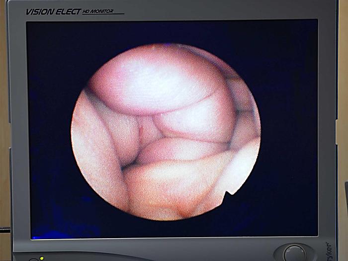 Used URETEROSCOPE OLYMPUS