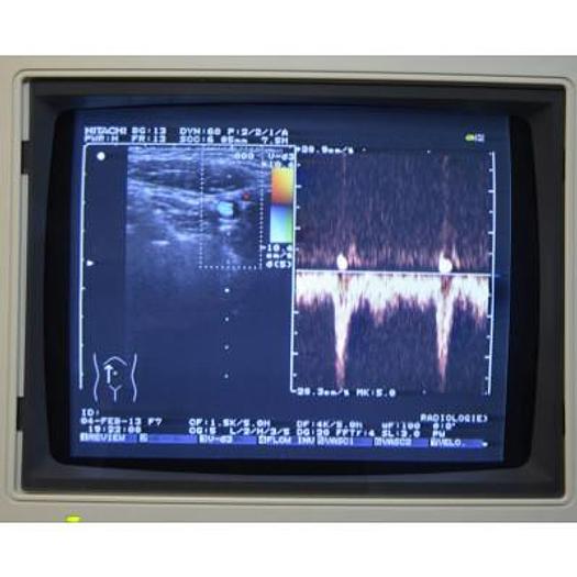 Used HITACHI EUB 525 COLOR DOPPLER ULTRASOUND SCANNER WITH 3 PROBES