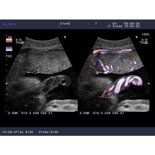 Used ALOKA SSD 4000 COLOR DOPPLER ULTRASOUND SCANNER