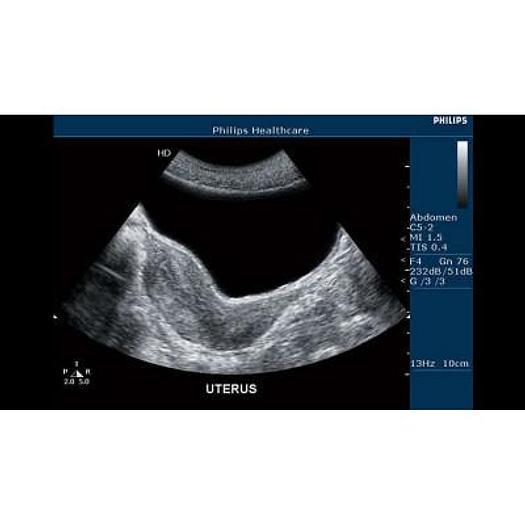 Used PHILIPS HD3 COLOR DOPPLER ULTRASOUND WITH ABDOMINAL PROBE AND ENDOVAGINAL PROBE