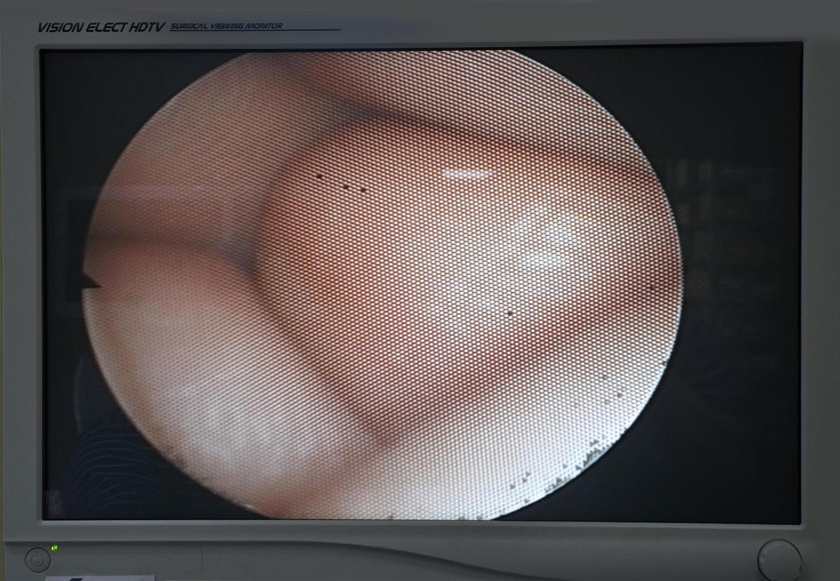 D'occasion STORZ 11101 RP2 NASOFIBROSCOPE