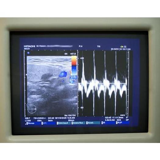 Used HITACHI HI VISION PREMIUM PLATFORM ULTRASOUND WITH 3 PROBES