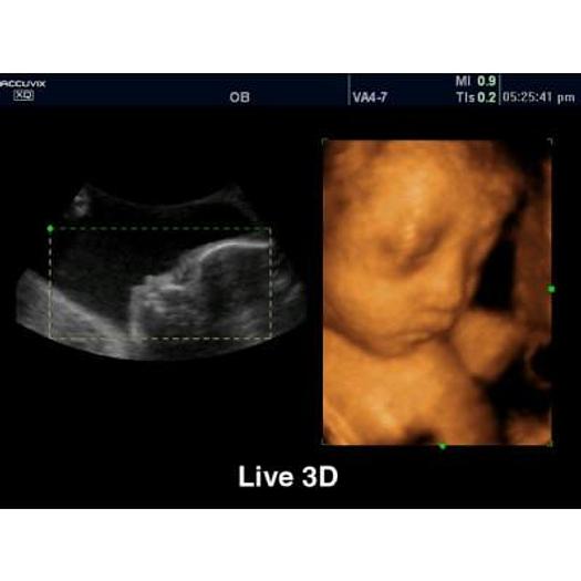 Used 3D/4D COLOR DOPPLER ULTRASOUND SCANNER, SAMSUNG MEDISON ACCUVIX XQ