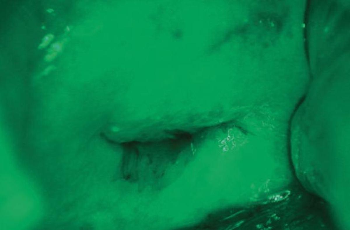 Rénové FAUTEUIL GYNÉCOLOGIQUE SCHMITZ MEDI-MATIC AVEC VIDEO COLPOSCOPE VIDAN INTEGRÉ ET ECRAN