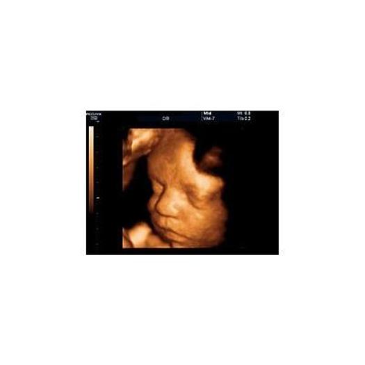 Used 3D/4D COLOR DOPPLER ULTRASOUND SCANNER, SAMSUNG MEDISON ACCUVIX XQ