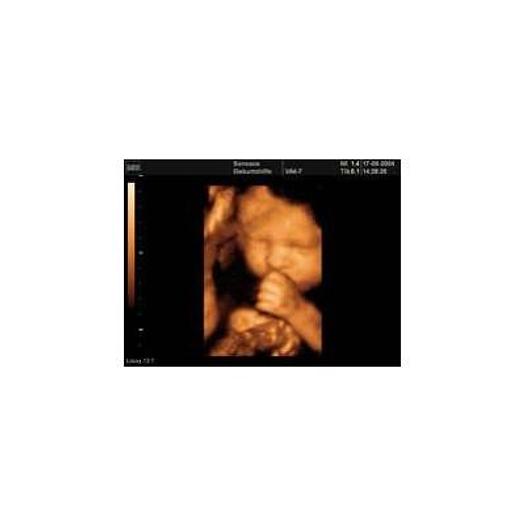 Used MEDISON SONOACE 8000 LIVE 3D/4D COLOR DOPPLER ECHOGRAPHY with 2 PROBES