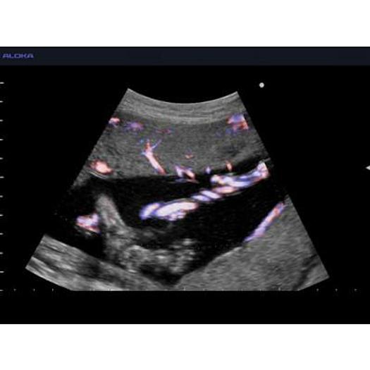 Used ALOKA SSD 4000 COLOR DOPPLER ULTRASOUND SCANNER