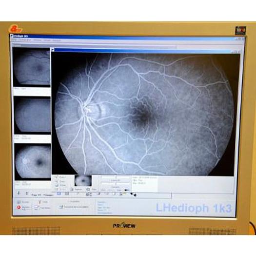 Used CANON CF-60UV DIGITAL ANGIOGRAPH WITH LHERITIER DIGITIZING SYSTEM