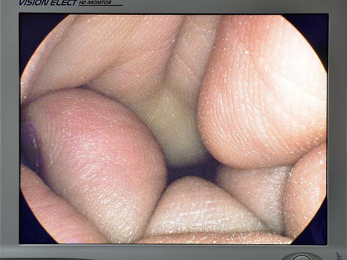 Used BIPOLAR RESECTION SET