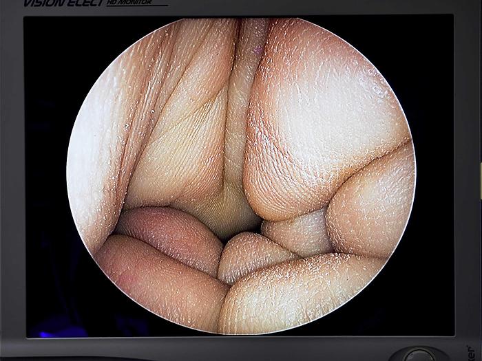 Used STRYKER KNEE ARTHROSCOPY SET