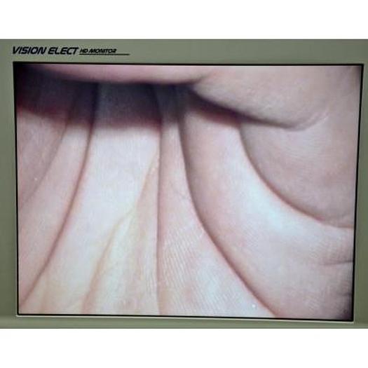 Used KAPPA VIDEOCOLPOSCOPE WITH 20X MAGNIFICATION, CART AND FLAT SCREEN