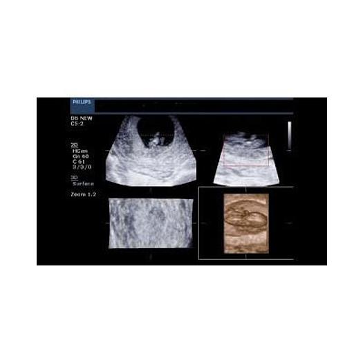 Used PHILIPS HD3 COLOR DOPPLER ULTRASOUND WITH ABDOMINAL PROBE AND ENDOVAGINAL PROBE