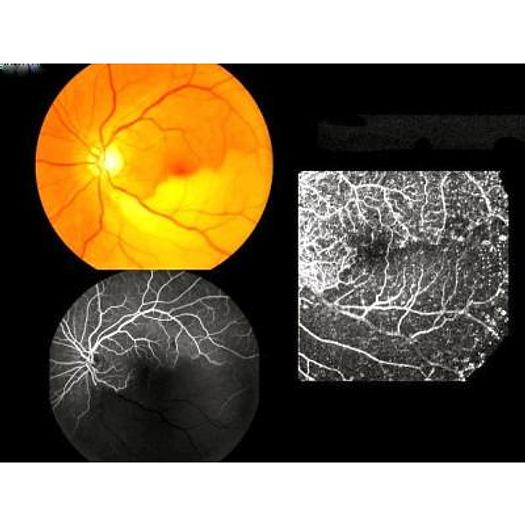 Used TOPCON TRC-50DX DIGITAL RETINAL IMAGING SYSTEM WITH PC AND RFI 3000 SOFTWARE