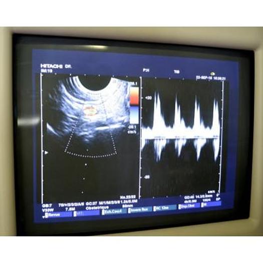 Used HITACHI EUB 6500 PLATFORM ELITE COLOR ULTRASOUND SCANNER WITH 4 PROBES