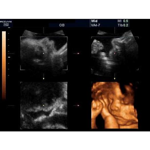 Used 3D/4D COLOR DOPPLER ULTRASOUND SCANNER, SAMSUNG MEDISON ACCUVIX XQ