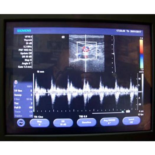 Used SIEMENS ACUSON X150 ULTRASOUND SCANNER WITH 3 PROBES AND FLAT SCREEN