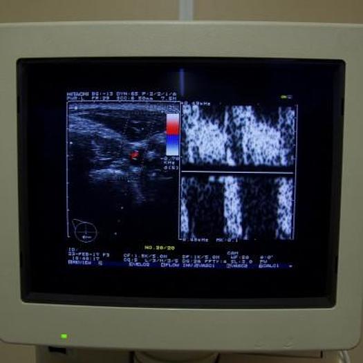 Used HITACHI EUB 525 COLOR DOPPLER ULTRASOUND WITH LINEAR PROBE