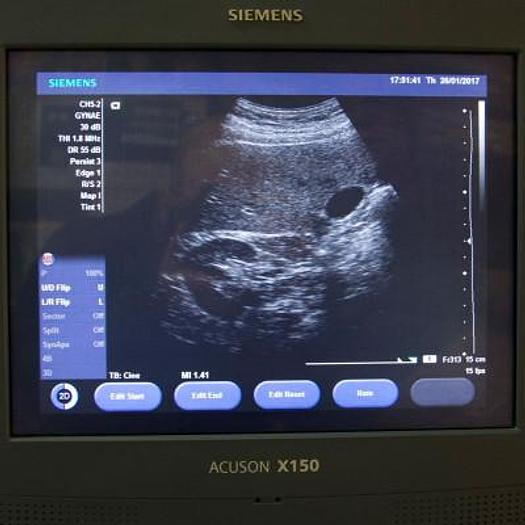 Used SIEMENS ACUSON X150 ULTRASOUND SCANNER WITH 3 PROBES AND FLAT SCREEN