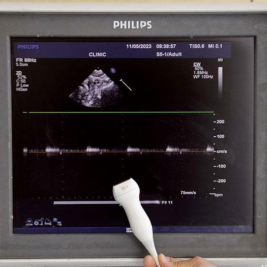 Used ECHOCARDIOGRAPHE PHILIPS IE33 RADIO CARDIO GYNECO