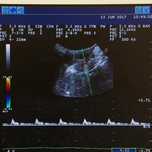 Used ESAOTE MYLAB 25 (2013) COLOR DOPPLER ECHOCARDIOGRAPH WITH 3 PROBES