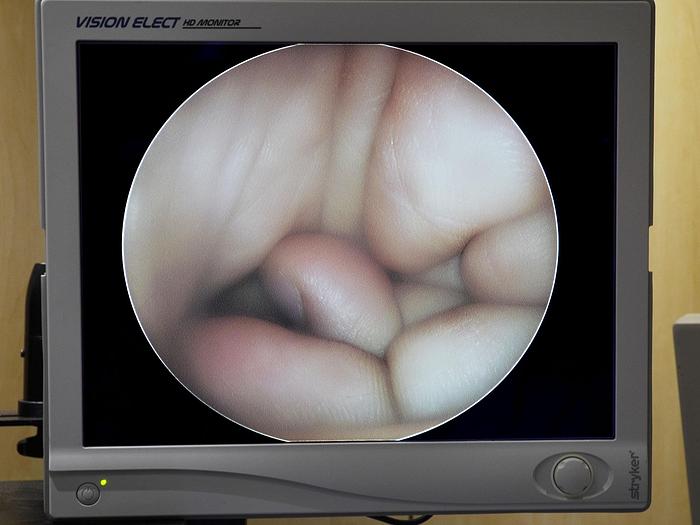 Used KARL STORZ SINGLE TAP URETEROSCOPE