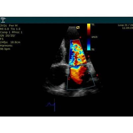 Used ACUSON SIEMENS CYPRESS COLOR PORTABLE ECHOCARDIOGRAPH WITH CART