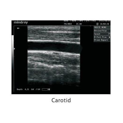 MINDRAY DP-10 ULTRASOUND SCANNER WITH LED MONITOR AND 1 CONVEX PROBE